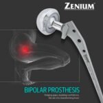 Bipolar Prosthesis RG Cemented
